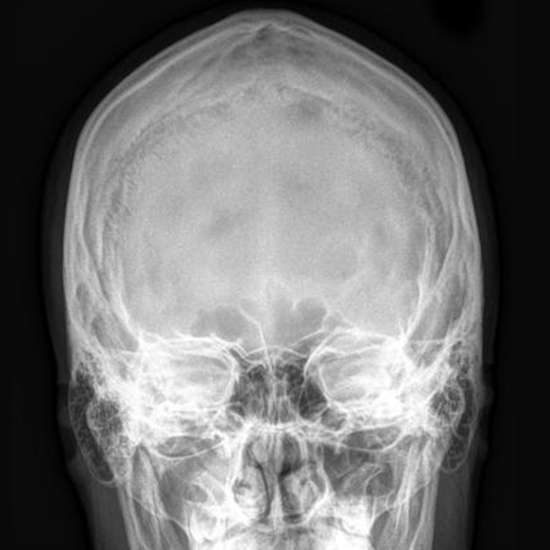X-Ray Skull PA / Occipito Frontal  View, Preparation, Procedure, and the Requirements